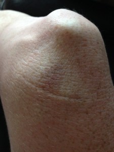 See that bruise there? I earned that!